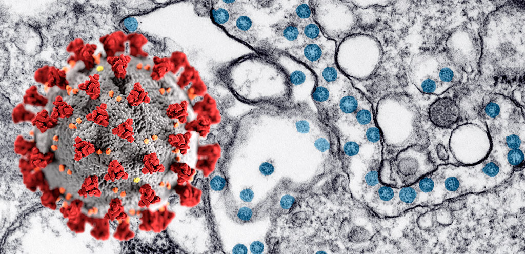 An illustration of Severe Acute Respiratory Syndrome coronavirus 2 (SARS-CoV-2) overlaid on a transmission electron microscopic image of an isolate from the first U.S. case of COVID-19
